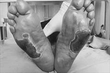 Bệnh nhân tiểu đường bị bỏng nặng hai bàn chân vì dùng “cặp đá kỳ diệu”